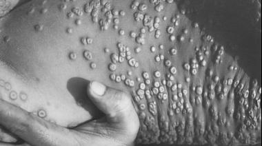 Viruela del mono: ¿Qué es esta enfermedad y por qué está siendo investigada?
