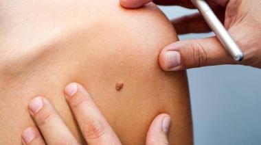 El gobierno de Tigre despliega una campaña para prevenir el cáncer de piel