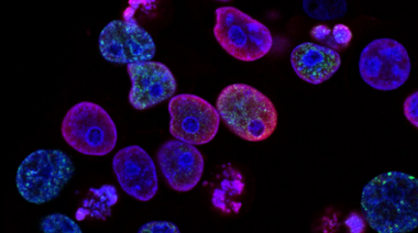 Lucha contra el cáncer: científicos de Argentina descubren tratamiento para frenar el crecimiento de tumores