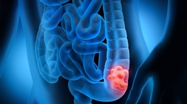 Distinguen dos desarrollos argentinos para el diagnóstico y tratamiento de cáncer de colon