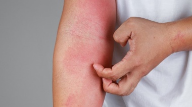 Dermatitis Atópica: Una patología tan frecuente como desconocida