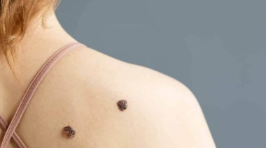 “MelaNOmás”: Decirle no más al melanoma depende de vos