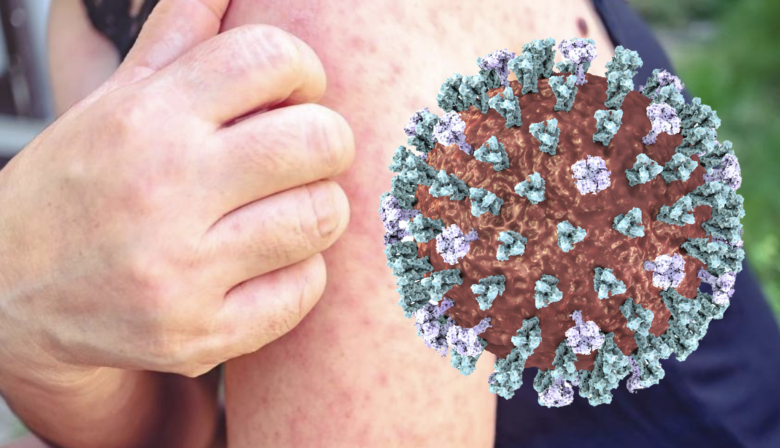 Nueva alerta de sarampión en Buenos Aires: crece la preocupación