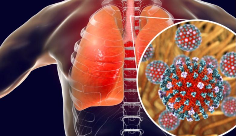 La Super Gripe H3N2 cobra su primera víctima en el país