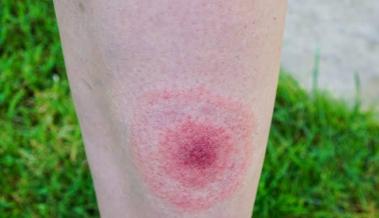 Qué es la enfermedad de Lyme, la infección que padece Bella Hadid y cuáles son sus síntomas