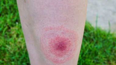 Qué es la enfermedad de Lyme, la infección que padece Bella Hadid y cuáles son sus síntomas