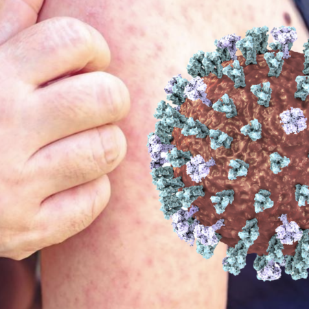 Nueva alerta de sarampión en Buenos Aires: crece la preocupación